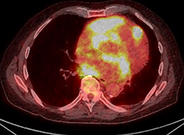 PET scan (transverse plane) demonstrating an enhancing lesion encroaching the heart with necrotic lymph nodes.