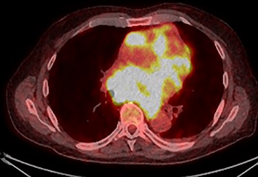 PET scan (transverse plane) demonstrating an enhancing lesion encroaching the heart with necrotic lymph nodes.
