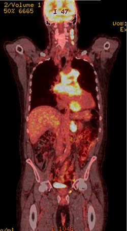 PET scan (coronal plane) showing intensely metabolically active lymphadenopathy on both sides with extra-nodal involvement through lymphoid tissue, adrenals and muscle.