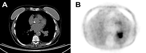 (A) Chest CT with contrast enhancement displaying a solid lung mass of 38 mm characterized by polycyclic margins and dysmorphic calcification. (B) PET/CT with fluorodeoxyglucose revealing high glucose metabolism of the lung mass in the perihilar region of the left inferior lung lobe, near the left inferior lobar bronchus.