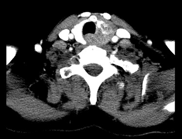 Chest CT showing an inhomogeneous alteration of the left thyroid lobe, corresponding to the metastatic thyroid involvement from the ACC.