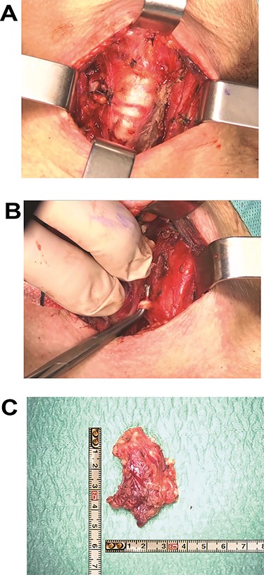 (A) Left thyroid lobe dissection with identification of noble structures. (B) Surgical field at the end of the total thyroidectomy with demonstration of tracheal involvement. (C) Macroscopic specimen of left thyroid lobe with neoplastic mass infiltrating perithyroidal tissues.