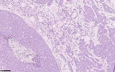 Histological section showing solid sheets, with comedo necrosis, and nests of neoplastic cells infiltrating thyroidal parenchyma (haemotoxylin and eosin, o.m. ×20).