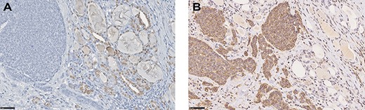 (A) IHC for TTF-1 demonstrating negativity in neoplastic cells, whereas nuclei of normal thyroid cells stain positive (IHC, DAB stain, o.m. ×40). (B) Nests of tumour cells positive for SMA infiltrating thyroid parenchyma between follicles (IHC, DAB stain, o.m. ×40).