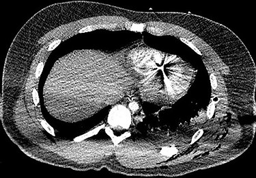 Axial CT scan of the chest identifying bullet fragment in the interventricular septum.
