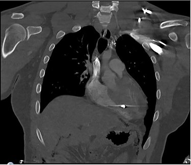 Coronal CT scan of the chest identifying bullet fragment in the interventricular septum.