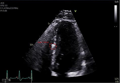 Echocardiogram identifying bullet fragment in the interventricular septum.