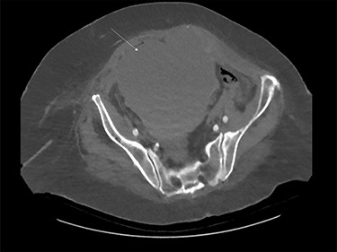 Large rectus sheath haematoma on computed tomography (white arrow).