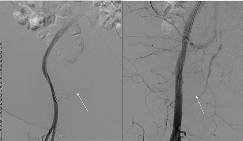 DSA showing left: flow through inferior epigastric artery (white arrow) and right: occlusion of inferior epigastric artery flow with covered stent in inferior epigastric artery.