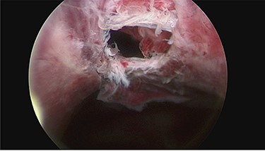 Cystoscopy showing perforation in anterior bladder wall communicating with the haematoma.
