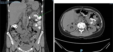 Coronal and axial slices of a CT abdomen/pelvis with oral contrast demonstrating a gastrocolonic fistula.