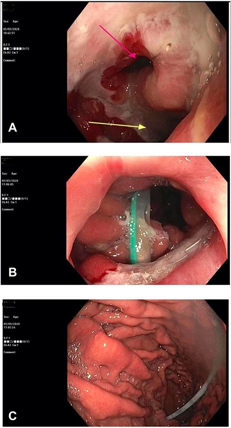 (A) Gastroscopy demonstrating a large gastrocolonic fistula (pink arrow) and gastrojejunostomy leading into the afferent jejunum (yellow arrow). (B) Image of colonoscopy at the splenic flexure demonstrating the gastrocolonic fistula with view of gastric mucosa and nasogastric tube. (C) The gastrocolonic fistula allowed passage of the colonoscope with relative ease. Image of gastric mucosa and nasogastric tube via the gastrocolonic fistula.