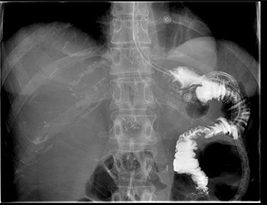 Gastrografin meal at 7 days post-operatively demonstrating resolution of gastrocolonic fistula.