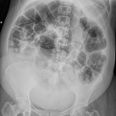 X-ray Abdomen, 24 h after commencement of symptoms. Widespread dilatation of large and small intestines stopping at the level of the pelvic brim. Moderate faecal loading in the caecum and descending colon.
