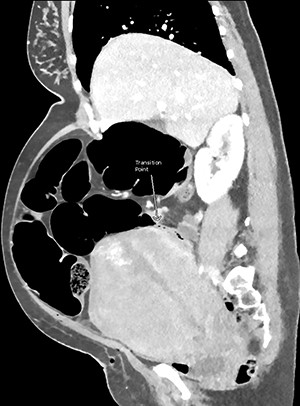 CT abdomen and pelvis with venous phase contrast, sagittal view. Abrupt collapse of the gas-filled sigmoid colon is shown posterior to the enlarged uterus. Subcutaneous gas in the anterior abdominal wall is from recent surgery.