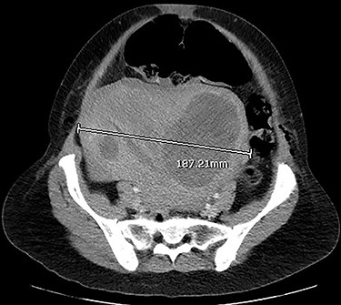 CT abdomen and pelvis with venous phase contrast, axial view. Polymyomatous uterus at its maximal width of 187.21 mm, 2 days postpartum. Note the larger fibroid on the right, reported to show necrotic changes. Dilated bowel loops visible anterior to the uterus.