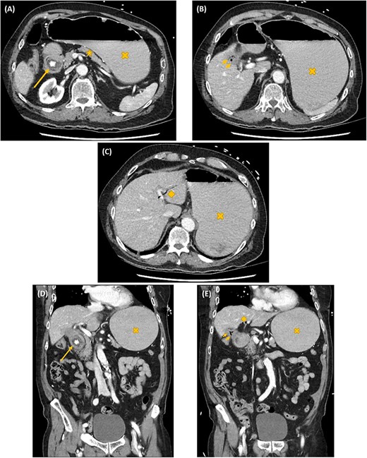 Axial (A–C) and coronal (D, E) computed tomography images showing gastric outlet obstruction (cross) due to a 3 cm hyperdense ectopic gallstone between the first and second parts of duodenum (arrow), with intrahepatic pneumobilia (diamond) and a decompressed gallbladder (arrow heads). This Rigler’s triad of findings was consistent with a cholecystoduodenal fistula and Bouveret syndrome.