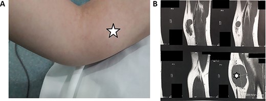 (A) Clinical findings of the mass; (B) MRI showing an intraneural well demarcated tumor, measuring 4.8 × 2.7 × 2.5 cm, which was hypointense on T1-weighted images (white star).