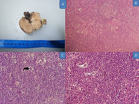 (A) Gross appearance of the mass; (B–D) Hodgkin lymphoma’s histology: neoplastic cells within a reactive inflammatory background: B (HE, x20O), C (HE X 400 black arrow showing RSB cell) and D (HE, X 400 white arrows showing Hodgkin cell).