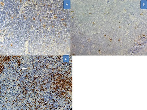 Immunohistochemistry findings (X 200); (A) positivity for CD30; (B) positivity for CD15; (C) positivity for Pax5 (white arrow for neoplastic cells).