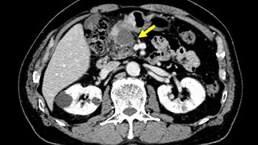 Abdominal CT showed the tumor at the gastric antrum visualized as a thickened wall, suggestive of direct invasion to the pancreatic head (arrow).