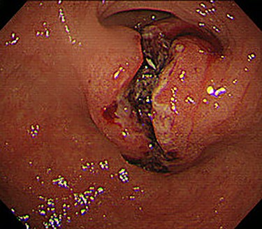 EGD revealed a large ulcerated lesion at the greater curvature of the antrum.
