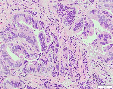 Hematoxylin and eosin staining of the biopsy specimen of the tumor confirmed a well-differentiated adenocarcinoma (tub1, tub2).