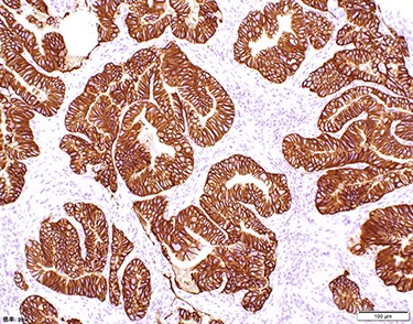 The assessment of the HER2 expression showed that all of the tumor cells had the overexpression of HER2 (Score 3).