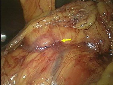 Laparoscopic finding showed that there was no peritoneal dissemination or liver metastasis, but the direct invasion of the gastric tumor to the pancreatic head was suspected (arrow).