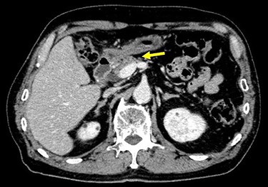 CT after the NAC had been completed showed a significantly shrunken tumor at the antrum that had become detached from the pancreatic head (arrow).