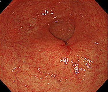 After the four cycles of NAC had been finished, EGD showed a markedly shrunken tumor at the antrum.