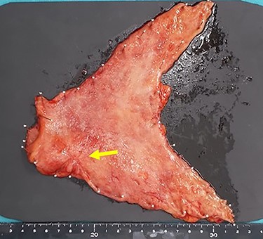 The macroscopic evaluation of the surgical specimen revealed a smaller ulcerative lesion than had been seen preoperatively, with no invasion to the serosa (arrow).