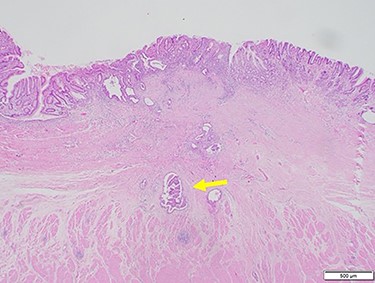 Microscopic findings of hematoxylin and eosin staining of the tumor showed a very small cluster of tumor cells; there was no lymph node metastasis (arrow).