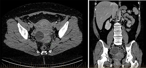 CT abdomen demonstrating pelvic pathology.