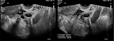 Ultrasound imaging of the right ovary, demonstrating a simple cyst.