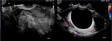 Left ovary with suspected tubo-ovarian complex.