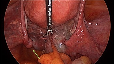 Left tubal torsion.