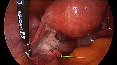 The left tube was torted three times.