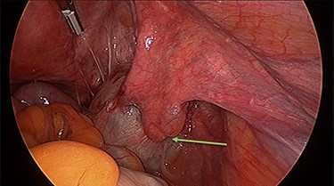 Right para-tubal cyst, implanted to the pouch of Douglas and right ovarian fossa.