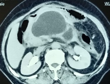 Contrast CT abdomen showing walled-off pancreatic necrosis in the pancreatic head, close to the distal bile duct.