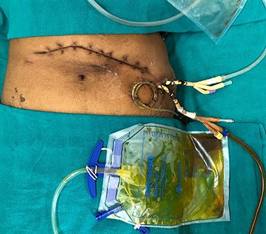 Imaging showing post-pancreatic necrosectomy status with bile leak in the lesser sac drain.