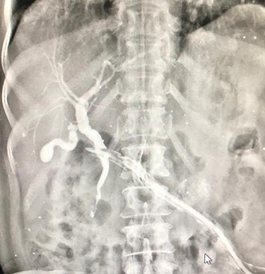 Fistulogram from the lesser sac drain showing biliary tree opacification.