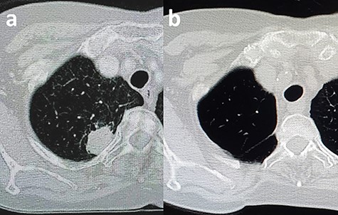 CT scan of the chest. (a) Shown is a tumor located adjacent to the rib’s neck and head. (b) This postoperation image shows the complete resection of the rib’s neck and head.