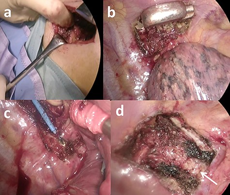 Images during the operation. (a) An additional posterior incision was made along the right paravertebral line. (b) The dorsal side of the third rib from the tumor was cut with a conventional rib cutter. (c) The costotransverse ligament, which holds the costovertebral joint, was divided with a conventional electrocautery. (d) The transverse process (arrow) was confirmed after complete resection of the rib neck and head.