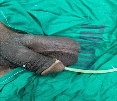 Swollen left hemi-scrotum. A urethral catheter in situ.