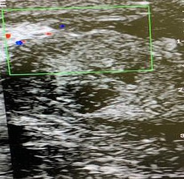 CDU scan showing lack of intratesticular blood flow and a collection of fluid within the testicular parenchyma.
