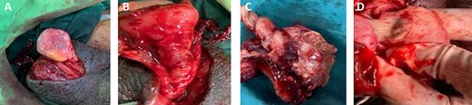 (A) A left dark testicle and a normal right testis that was relatively easy to exteriorise from the scrotal sac; (B) intravaginal spermatic cord twisting with copious exudate within the tunica vaginalis; (C) specimen after orchidectomy with about 540 degrees twist and (D) inadvertent rupture showing intratesticular pus.