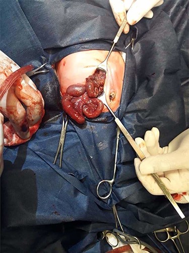 Operative view: ileal segmental volvulus.