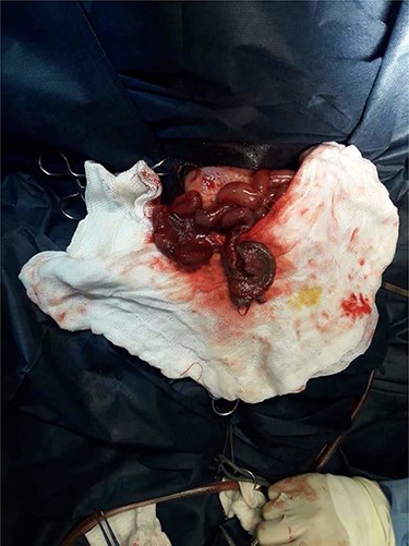 Operative view: necrotic perforated intestinal segment.