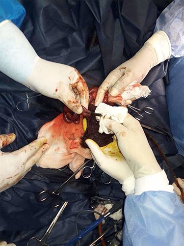 Operative view: viscous thick meconium; being removed by intraluminal irrigation.
